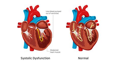 systolic heart failure symptoms.